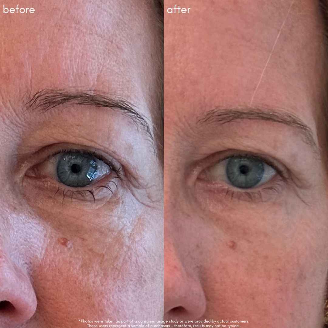 The Advanced Eye Response Complex Before and After