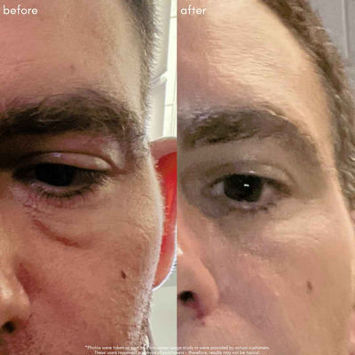 The Advanced Eye Response Complex Before & After