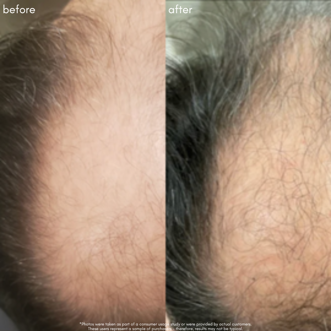 Power Fol *Jumbo* - Advanced Multi-Correctional Scalp & Hair Treatment - Maya Chia Before + After