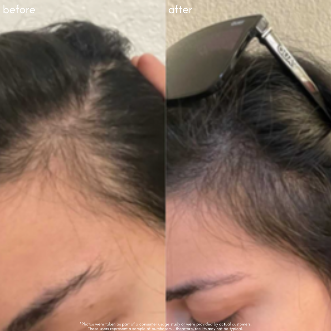 Power Fol - Advanced Multi-Correctional Scalp & Hair Treatment - Maya Chia Before + After