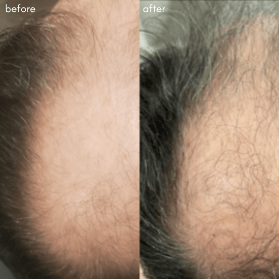 Power Fol - Advanced Multi-Correctional Scalp & Hair Treatment