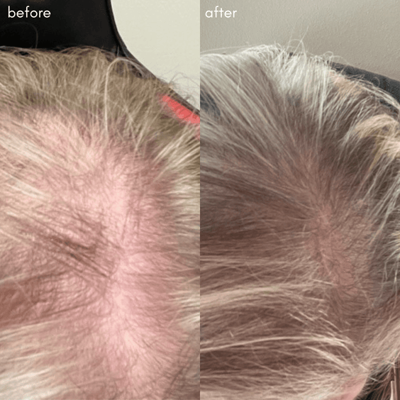 Power Fol Before After Results