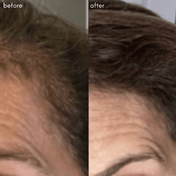 Power Fol Before After Results