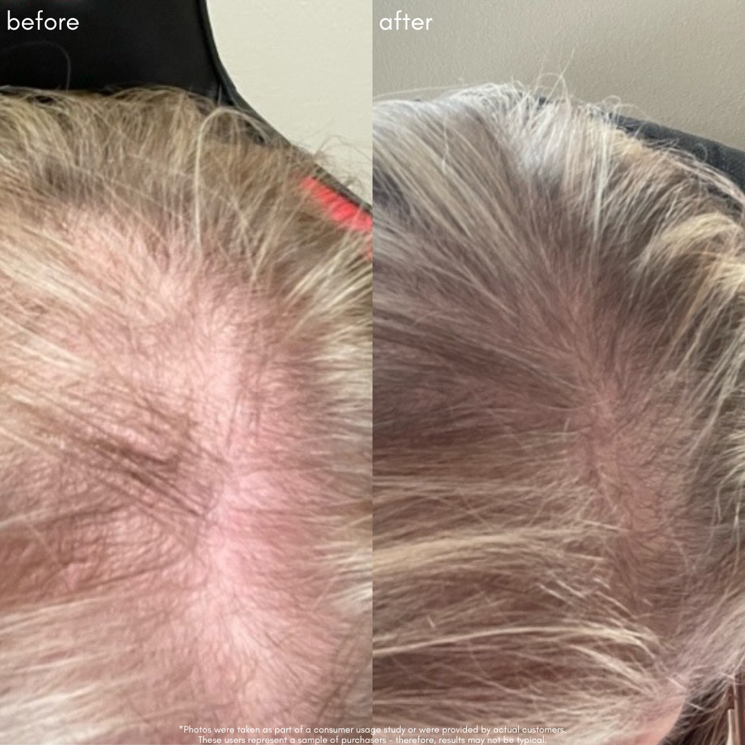 Power Fol - Advanced Multi-Correctional Scalp & Hair Treatment - Maya Chia Before + After