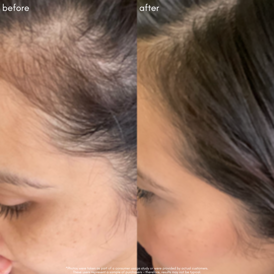 Power Fol - Advanced Multi-Correctional Scalp & Hair Treatment - Maya Chia Before + After